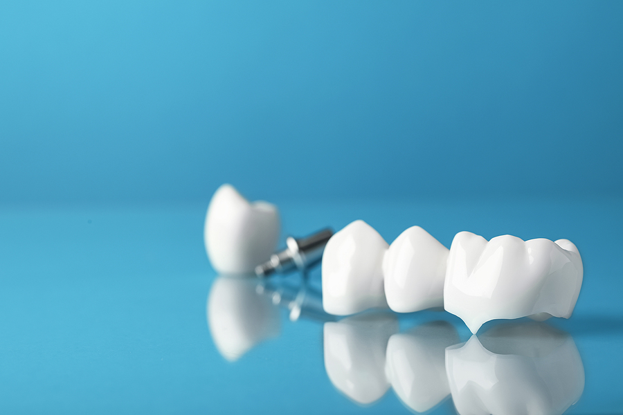 The Benefits of Dental Crowns