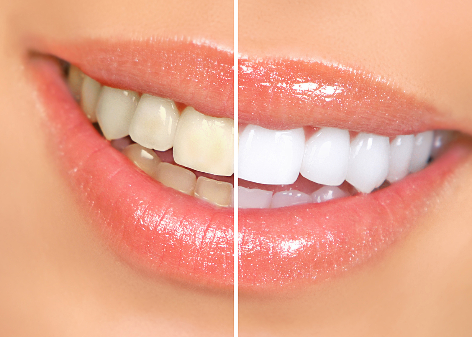 Brighten Your Smile: The Benefits of Teeth Whitening in Renton, WA